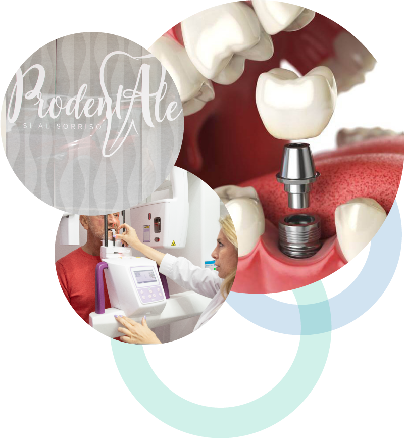 Implantologia dentale | Prodentale